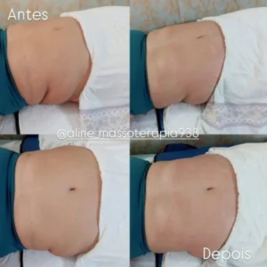 20% DE DESCONTO EM DRENAGEM LINFÁTICA